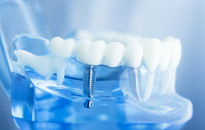 Dental Implants to Save Your Teeth