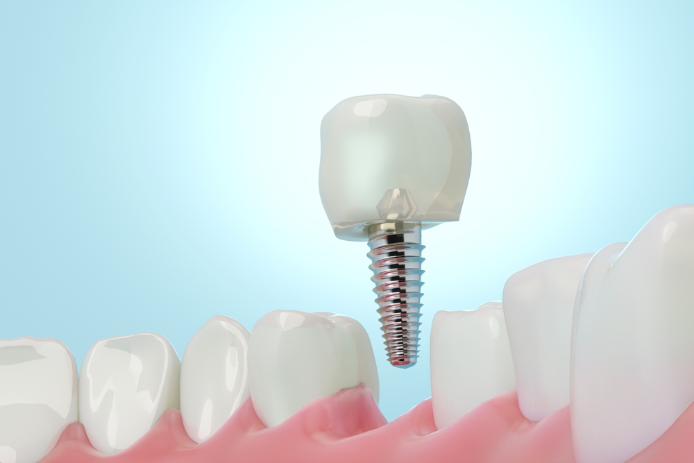 Dental Implants: The Most Advanced Way To Rebuild Your Smile!