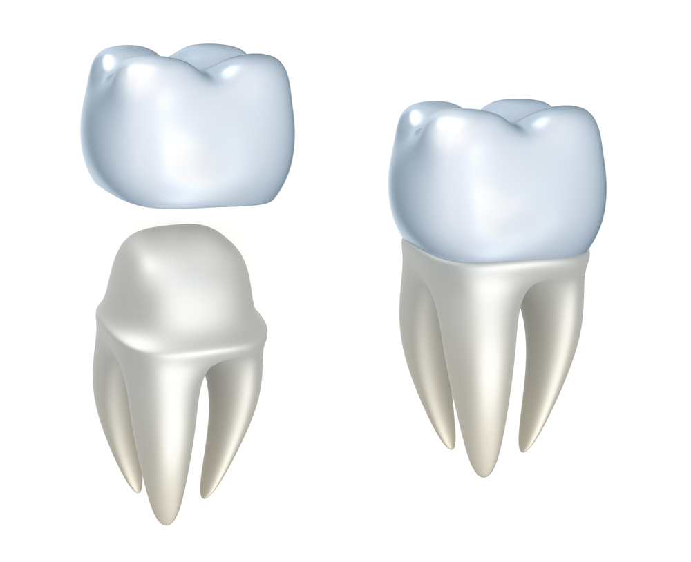 dental crowns burlington ct