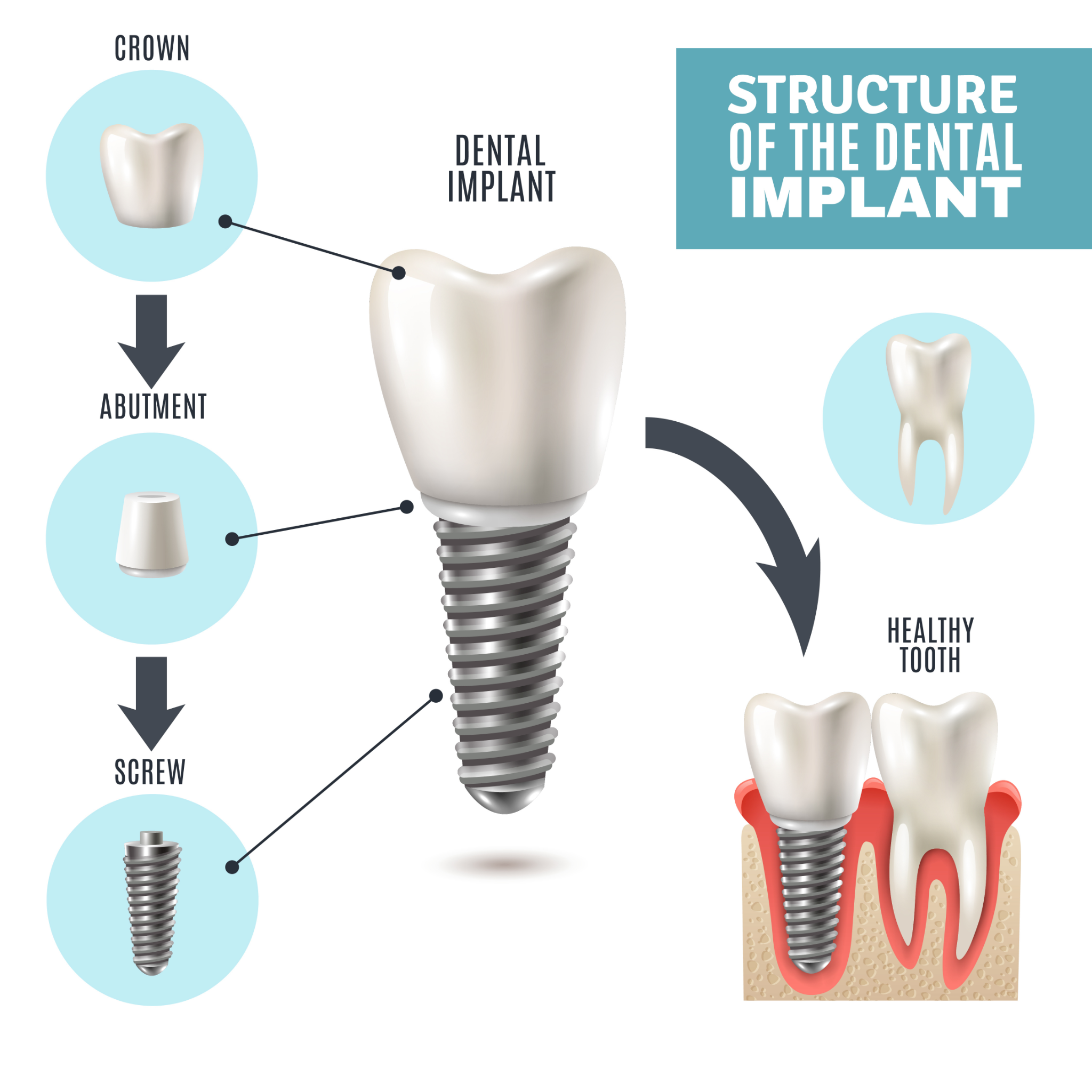 dental implants burlington ct
