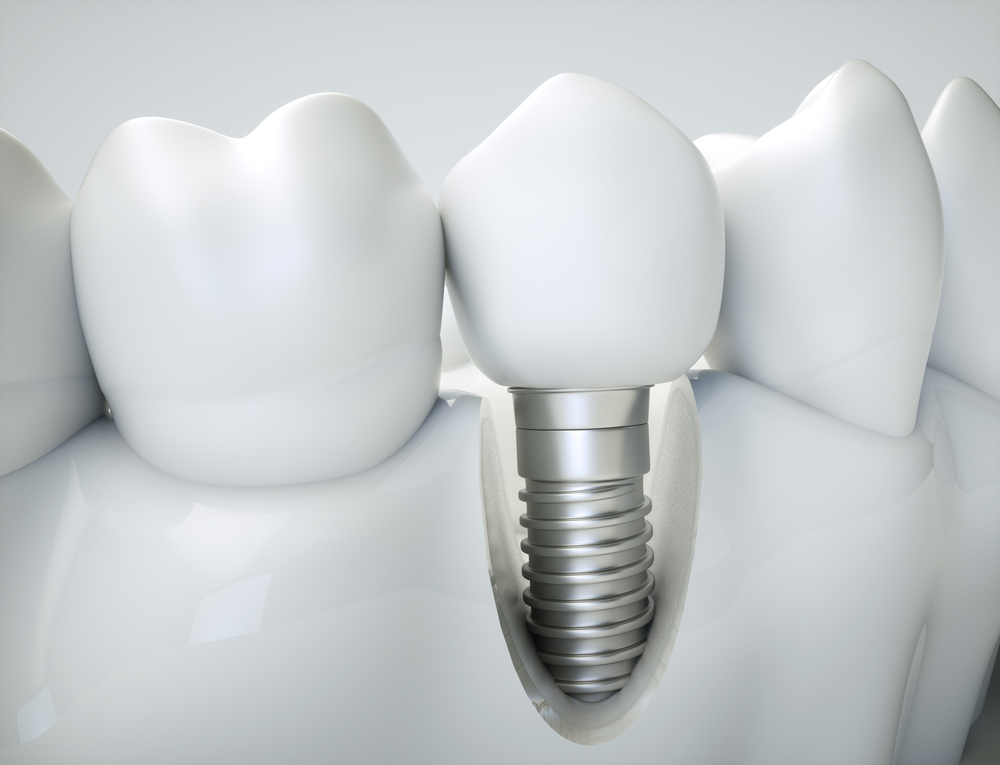 Dental Implants Let You Smile Again