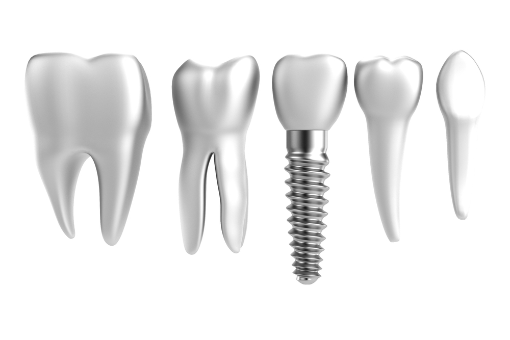 Regain Confidence with Dental Implants