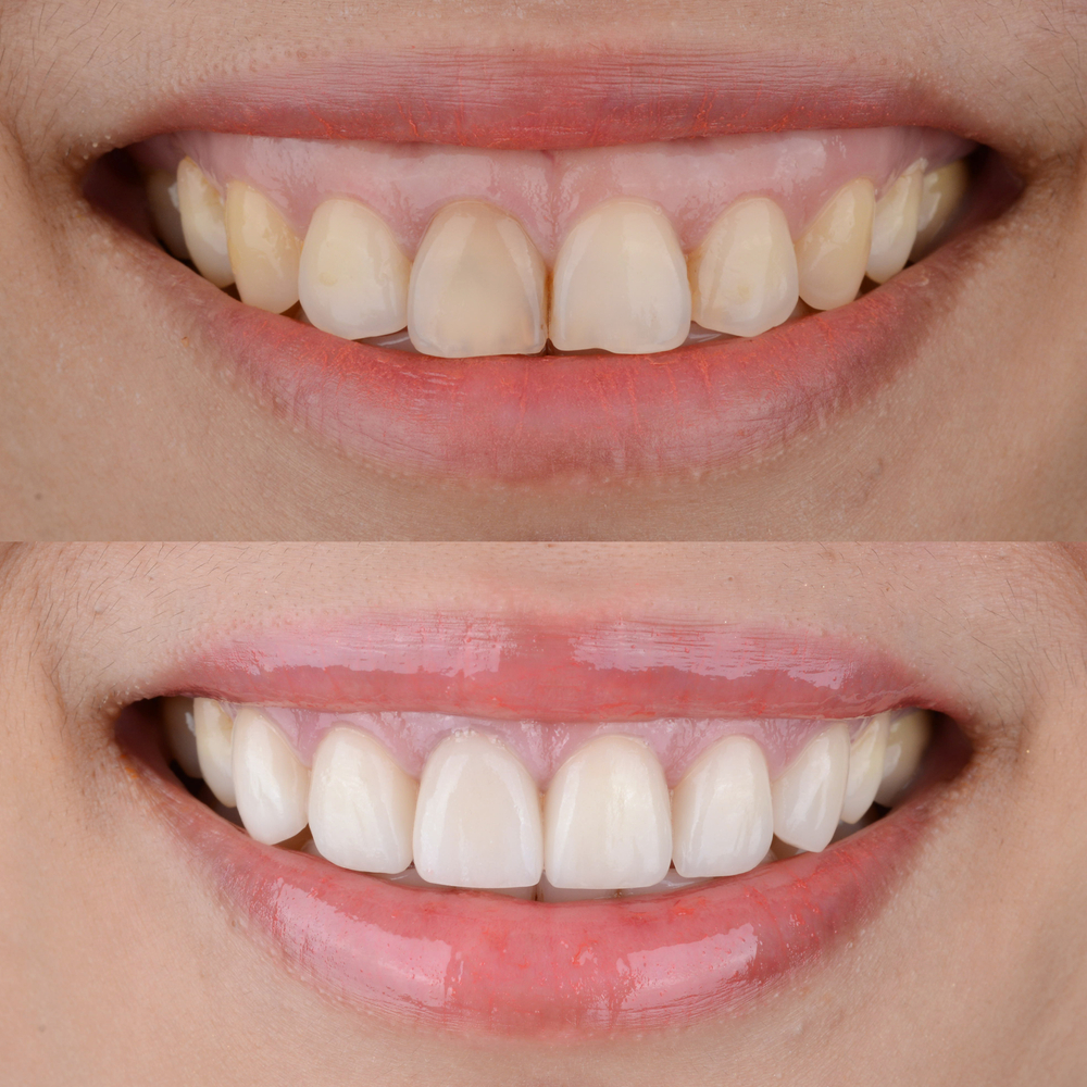 dental veneers burlington ct