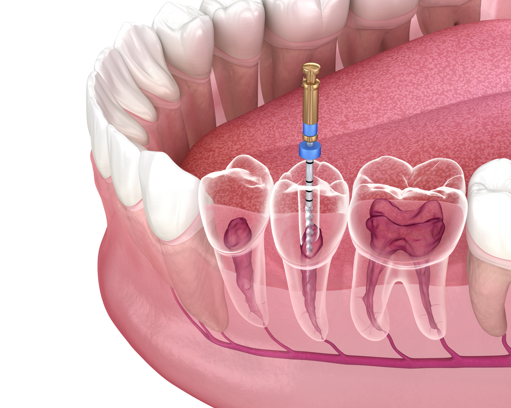 root canal burlington ct