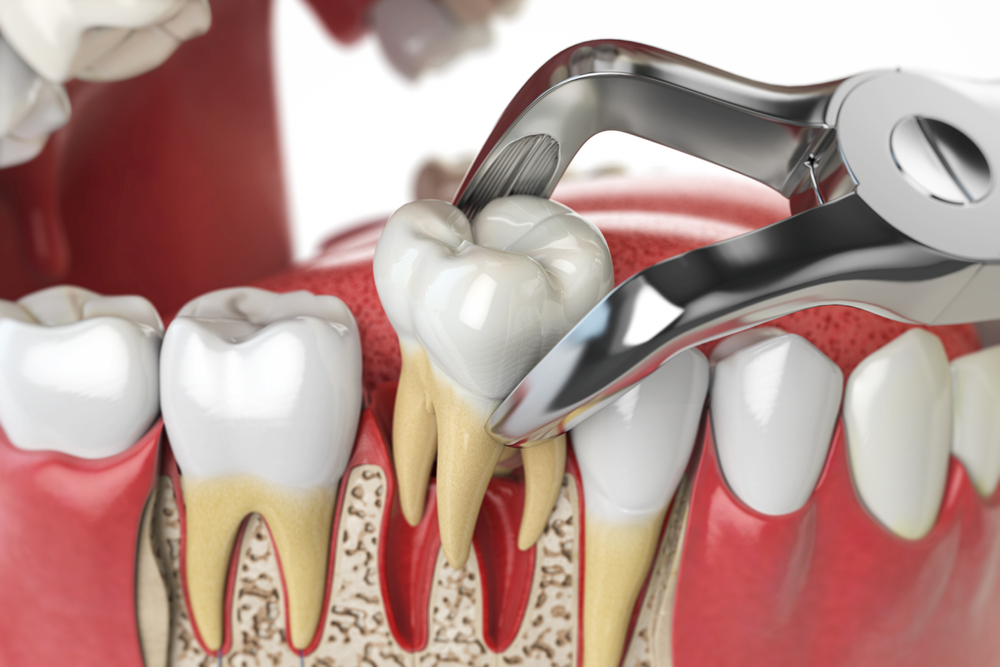 tooth extraction burlington ct