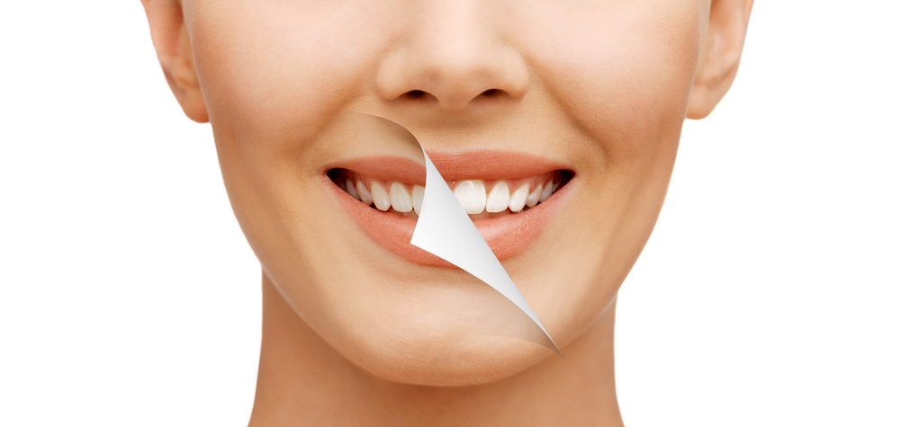 teeth whitening burlington CT