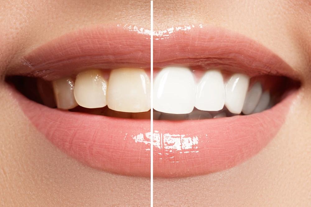 In-Office Teeth Whitening: The Fast Track to a Brighter Smile