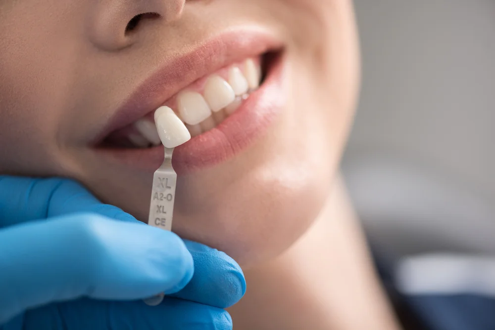 How Take-Home Whitening Kits Work